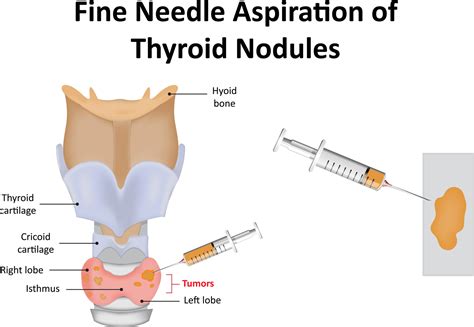 Fine Needle Aspiration Of Thyroid Nodules Mmra