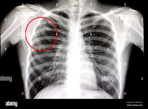 Chest X Ray Image Of Patient With Pulmonary Tuberculosis Stock Photo