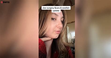 Woman Undergoes 200k Jaw Surgery After Being Bullied For Her ‘squirrel