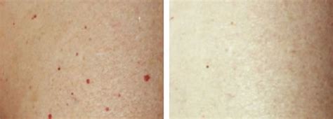 Red Mole Cherry Angioma Laser Removal