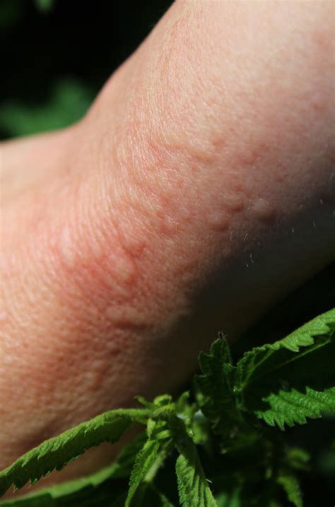 The Best Way To Treat Nettle Stings Fast