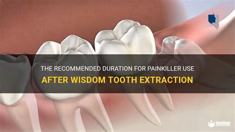 The Recommended Duration For Painkiller Use After Wisdom Tooth