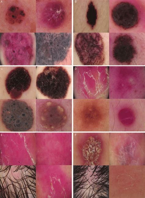 Example Dermoscopic Images Basal Cell Carcinoma A Melanocytic Nevus