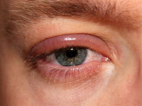 What Causes Dry Eyelids 15 Common Causes You Should Know Optinghealth