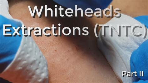 Whiteheads Extraction Tntc Session I Part 2 Of 3 Youtube