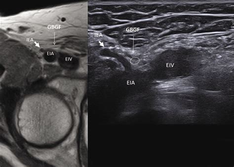 A Us Image Of The Right Genital Branch Of The Genitofemoral Nerve