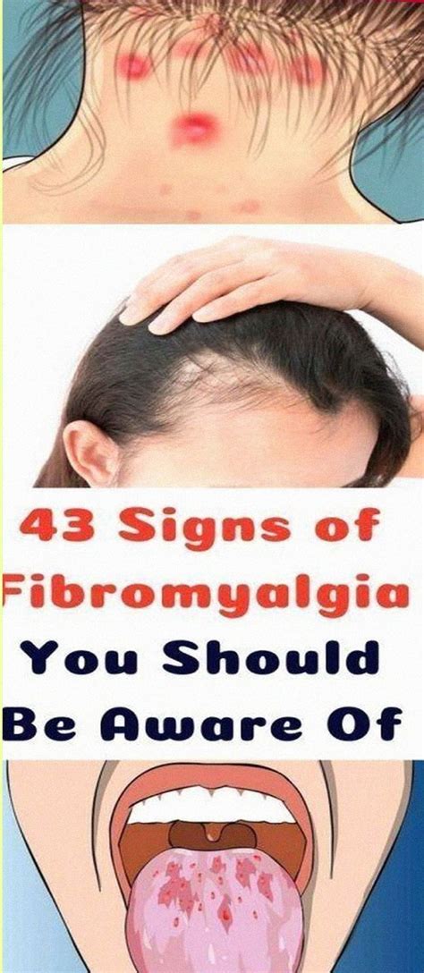 43 Signs Of Fibromyalgia You Should Be Aware Of In 2022 Signs Of Fibromyalgia Fibromyalgia