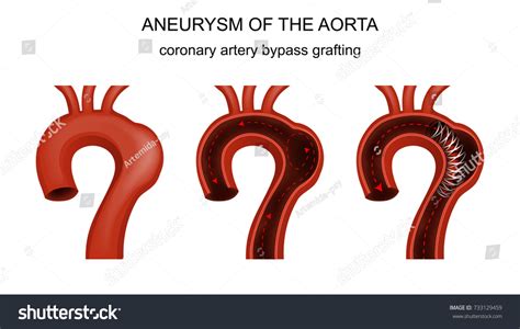 Vector Illustration Coronary Artery Bypass Grafting Stock Vector
