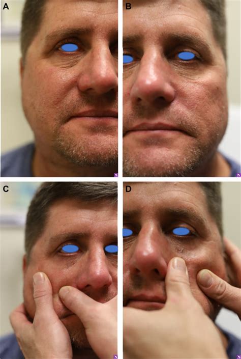 Treatment Of Periorbital Vascularity Erythema And Hyperpigmentation