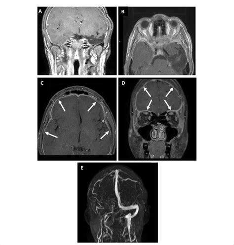 Mri Mrv Brain And Orbit Scans With Gadolinium At Presentation A D Download Scientific