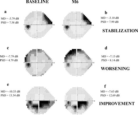 Examples Of Visual Field Progression From Three Patients With Proven