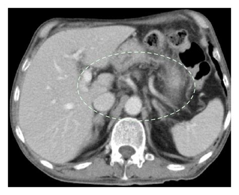 A Abdominal Ct Showing Enlarged Para Aortic Lymph Nodes B After