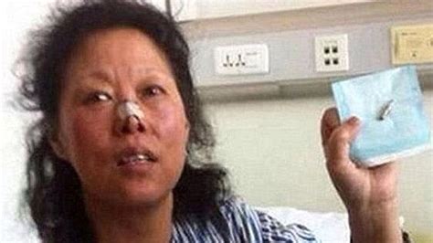 Una Mujer Vivió 48 Años Con Una Bala En La Cabeza