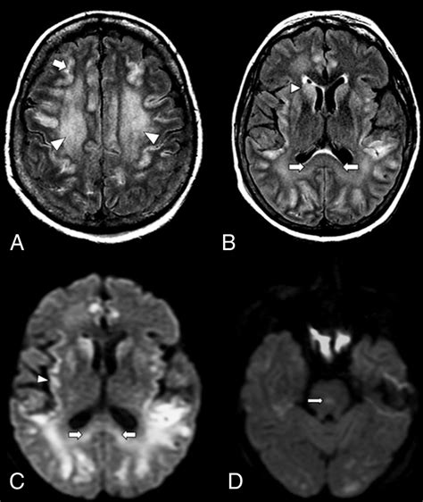 Imaging Features Of Acute Encephalopathy In Patients With Covid 19 A