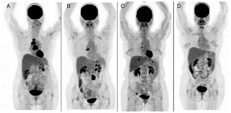 Staging Recurrent Ovarian Cancer With 18fdg Petct