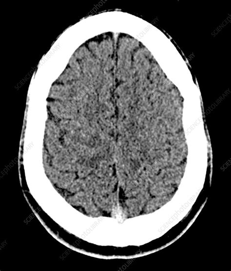 Concussion Ct Scan Stock Image C0306009 Science Photo Library