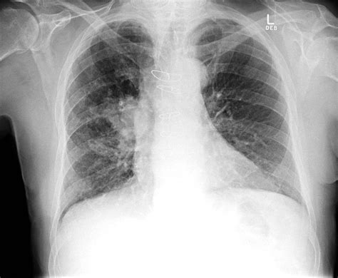 Small Cell Lung Cancer Chest X Ray