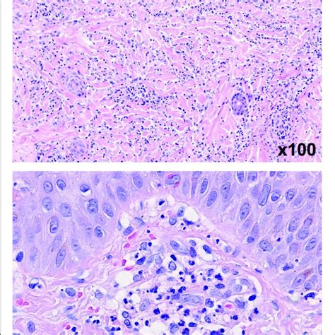 Hemorrhagic Bullae Developed On Both Feet An Lower Legs A C A Deep