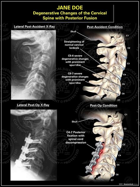 Degenerative Changes Of The Cervical Spine With Posterior Fusion