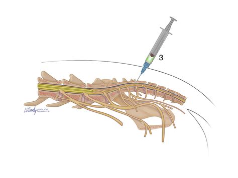 Local Anesthetic Techniques For Perineal Procedures