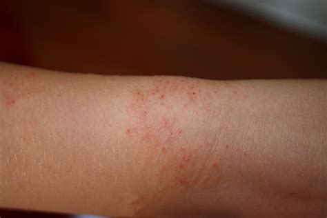 Wrist Rash Pictures