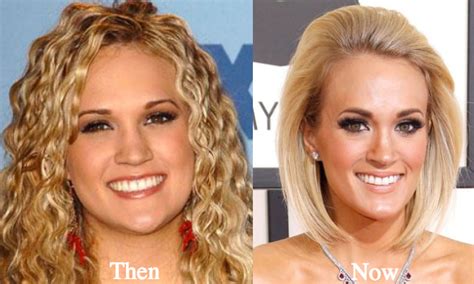 Carrie Underwood Plastic Surgery Before And After Photos