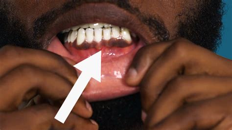 Heres Why Some People Have Black Gums