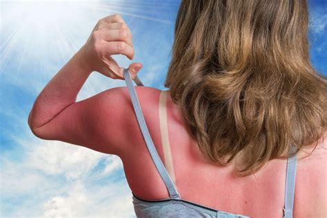 what happens when your skin gets sunburned vitali skincare