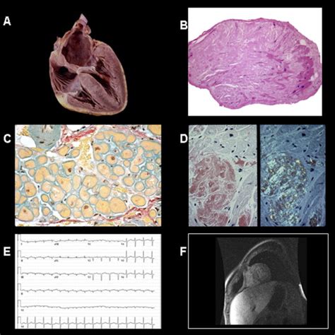 Cardiac Amyloidosis A Practical Approach To Diagnosis And Management