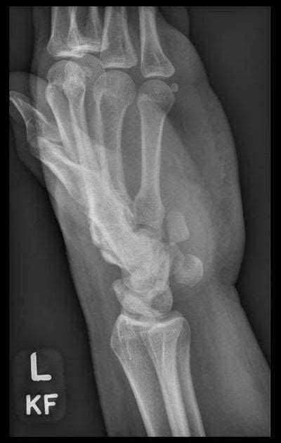 Hamate Fracture Classification Radiology Reference Article