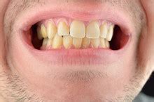 My Yellow Teeth Free Stock Photo - Public Domain Pictures
