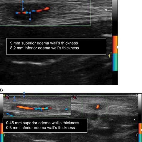 Pdf Color Duplex Ultrasonography Findings Of Temporal Arteries In A