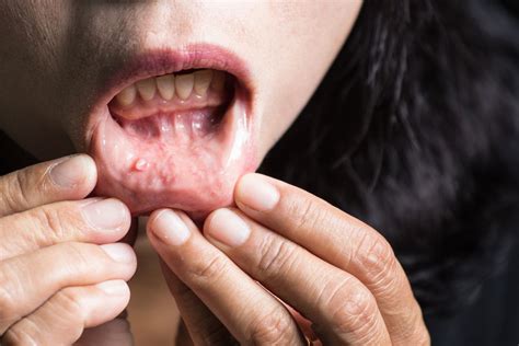 Mouth Cancer Causes Symptoms Treatment Safar Medical