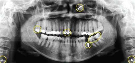 The Art Of Dental Radiography Dimensions Of Dental Hygiene Magazine