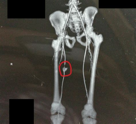 Full Text Traumatic Pseudoaneurysm Of The Superficial Femoral Artery