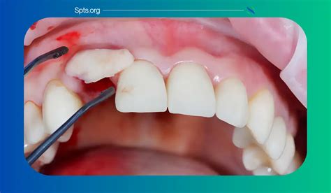 Dental Bone Graft Healing Stages My Personal Experience