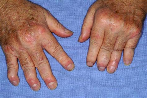 Psoriatic Arthritis Photos And Signs