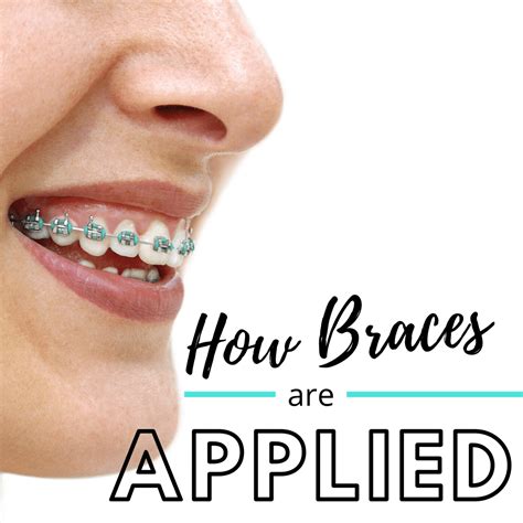 3 can i stop my overbite from getting worse? How Braces are Applied