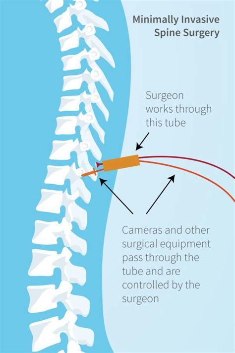Minimally Invasive Spinal Surgery Specialist Akron Oh Mark R Grubb