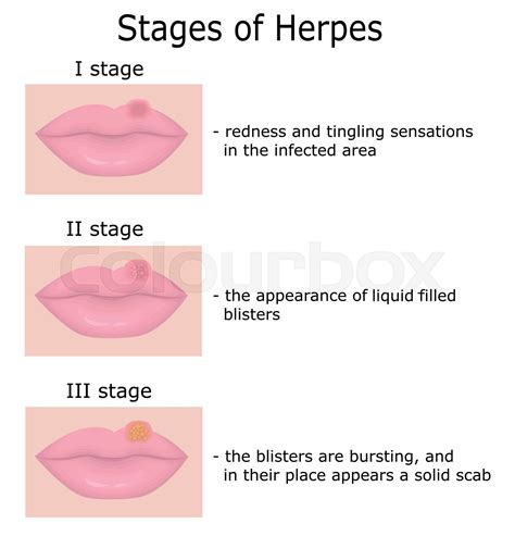Stages Of Herpes Stock Vector Colourbox