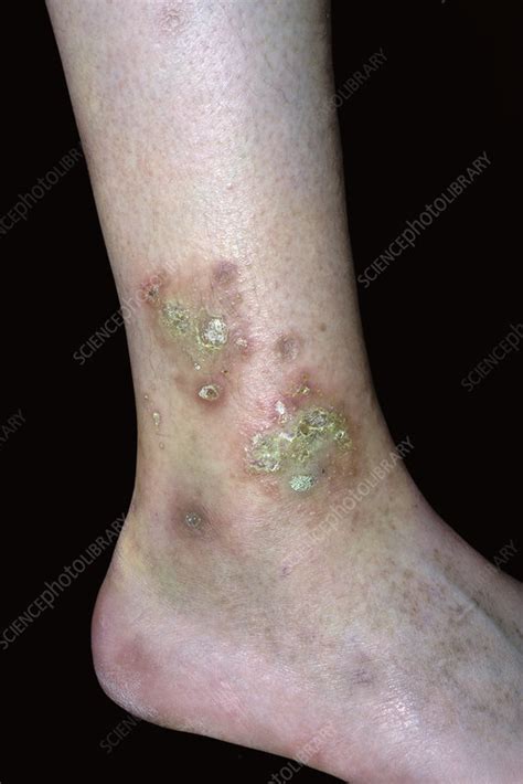 Diabetic Skin Lesions Stock Image C0515534 Science Photo Library