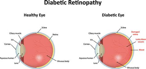 Diabetic Retinopathy Las Vegas Nevada Eye Physicians Henderson