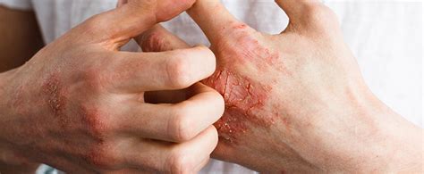 What Is Psoriatic Arthritis And How Do You Treat It Orthopedic
