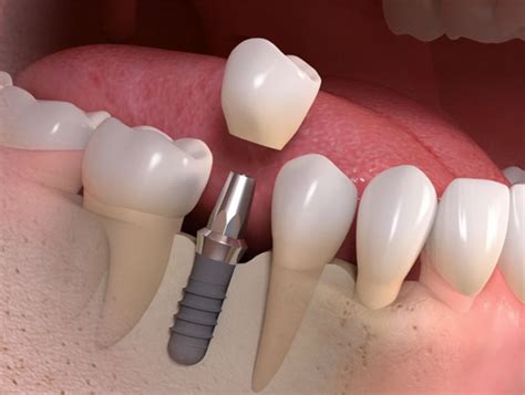 Implant Crown Replace Single Missing Tooth Permanently