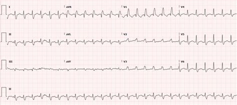 Dr Smiths Ecg Blog A Wide Complex Tachycardia