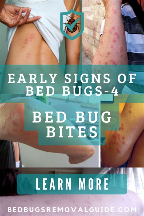 some people with bed bugs on their butts and the words early signs of bed bugs 4 bed bug bites