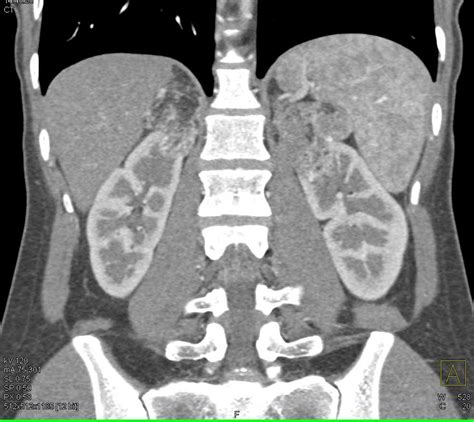 Bilateral Renal Angiomyolipomas In A Patient With Tuberous Sclerosis