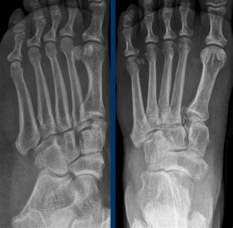 The Radiology Assistant Foot And Ankle Cases