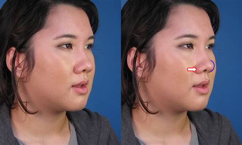 Asian Rhinoplasty Nose Job Surgery By Expert Ethnic Nose Surgeon Dr Hilinski Dr Hilinski