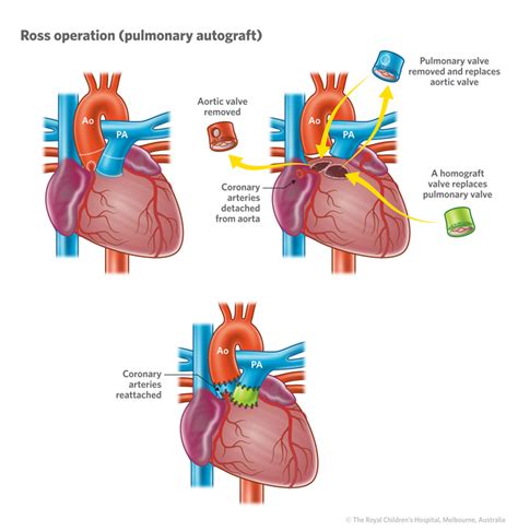 Cardiology Aortic Incompetence And Ross Procedure